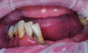 Имплантация зубов <br> в Санкт-Петербурге <br> под ключ
<br>
<span class="text-primary text-primary-gradient">За 2 часа за 119.000₽</span>